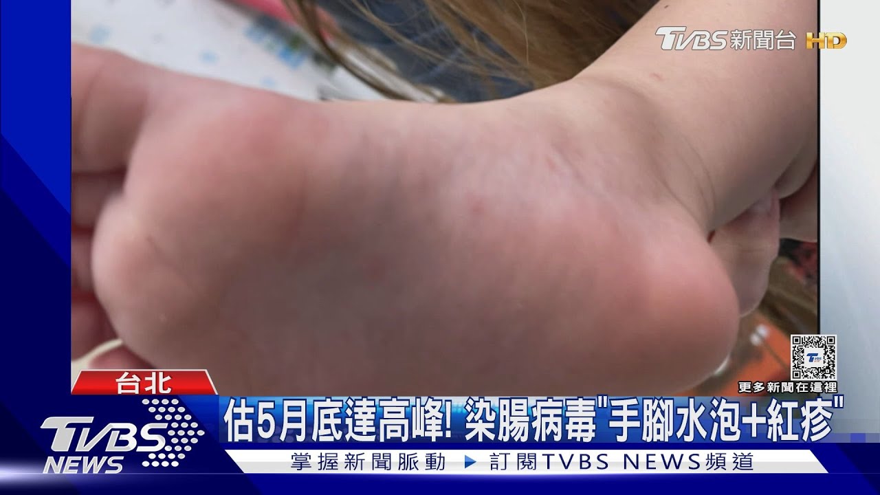 腸病毒10年新高「2嬰重症」 北市已227班停課