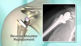 Reemplazo de Hombro y Prótesis Invertida en pacientes con dolor de hombro - Dr. Sanchez-Sotelo