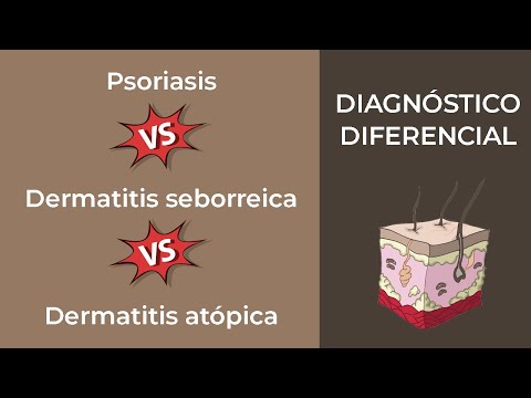 Epidemiology of psoriasis