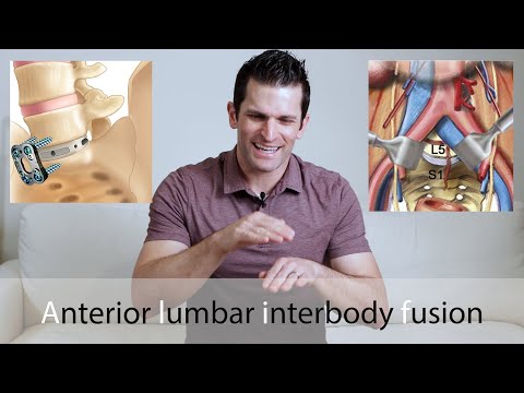ALIF Surgery // Anterior lumbar interbody fusion