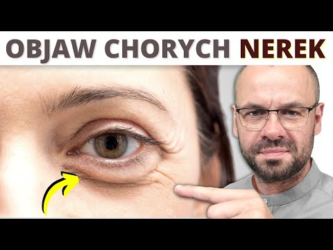 13 oznak, że NERKI wołają o pomoc.