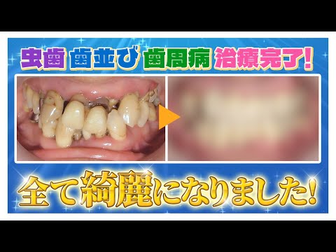 【虫歯、歯周病】ボロボロ・グラグラからの復活‼️