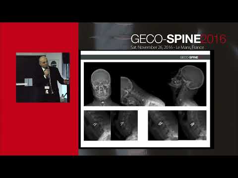 Instability of cervical disc replacement