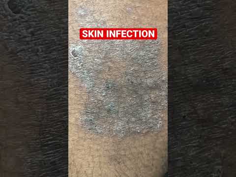 Rabhico ringworm ointment ayurvedic skin fungal infection ma...
