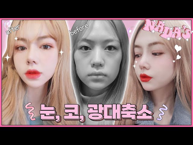 유노성형외과_전후사진/후기_리얼TV 유노성형외과_전후사진/후기_리얼Tv