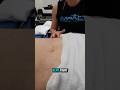 Dry Needling Vs Scar Tissue Scartissue Dryneedling Physicaltherapy Painrelief