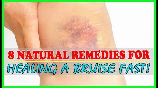 How To Get Rid Of Bruises Fast And Naturally? - Bruise Treatment | Best Home Remedies