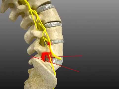 Hypoplasie der Hüftgelenke bei Neugeborenen Behandlung Als Brust-Osteochondrose Video zu behandeln