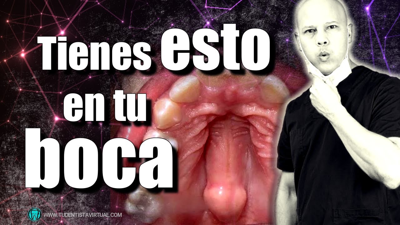 Bolas o bultos DUROS en la BOCA (paladar y encía) TORUS y EXOSTOSIS