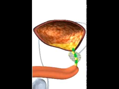 Samenerguss für Prostata Ausübung der Medizin für Prostata-Adenom