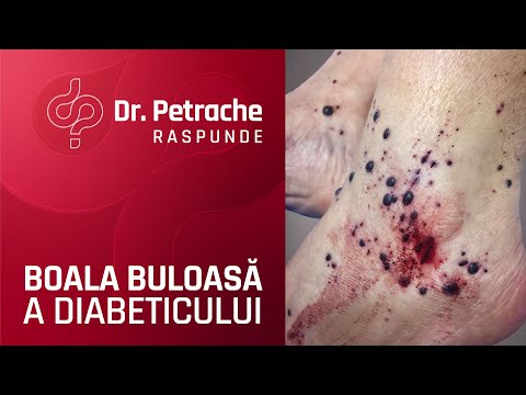 vegetarianismul din varicoseza care este teribilul varicoza