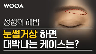 [성형의 해법] 눈썹거상 이런 분들이 받아야 합니다 | 눈썹거상 대박나는 케이스