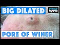 The Biggest Dilated Pore of Winer?! The Biggest Dilated Pore of Winer?!