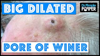 The Biggest Dilated Pore of Winer?!