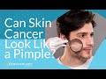Can Skin Cancer Look Like a Pimple?
