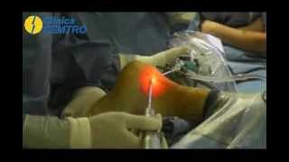 Calcaneoplastia contra la inflamación del tendón de Aquiles