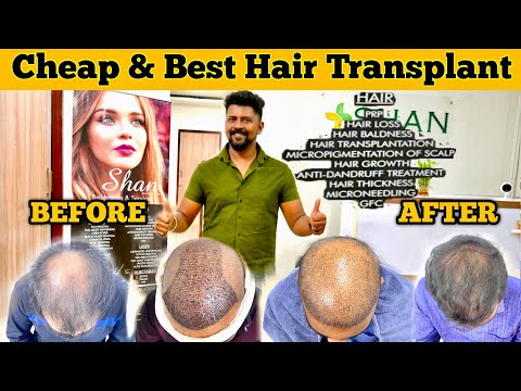 Cheap & Best HAIR TRANSPLANT / Best Price in Tamilnadu...