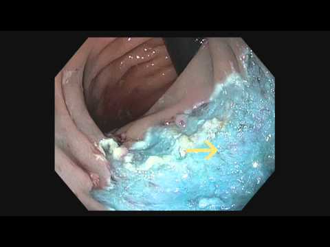 Endoscopic Resection of a Large Sigmoid Polyp Complicated by Delayed Bleeding