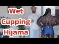 William Bonac | BACK INJURY | Wet Cupping | Hijama