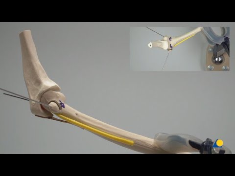 Humerus, Distal—Pediatric Supracondylar Fracture 13-M_3.1 III and IV—Fracture Management