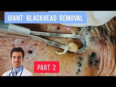 Massive blackhead removal inside a dermatology clinic | @Dr.AMAZINGSKIN