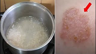 How To Cure Your Eczema & Rashes Naturally - Relieve Itchy Skin Fast & Permanently!