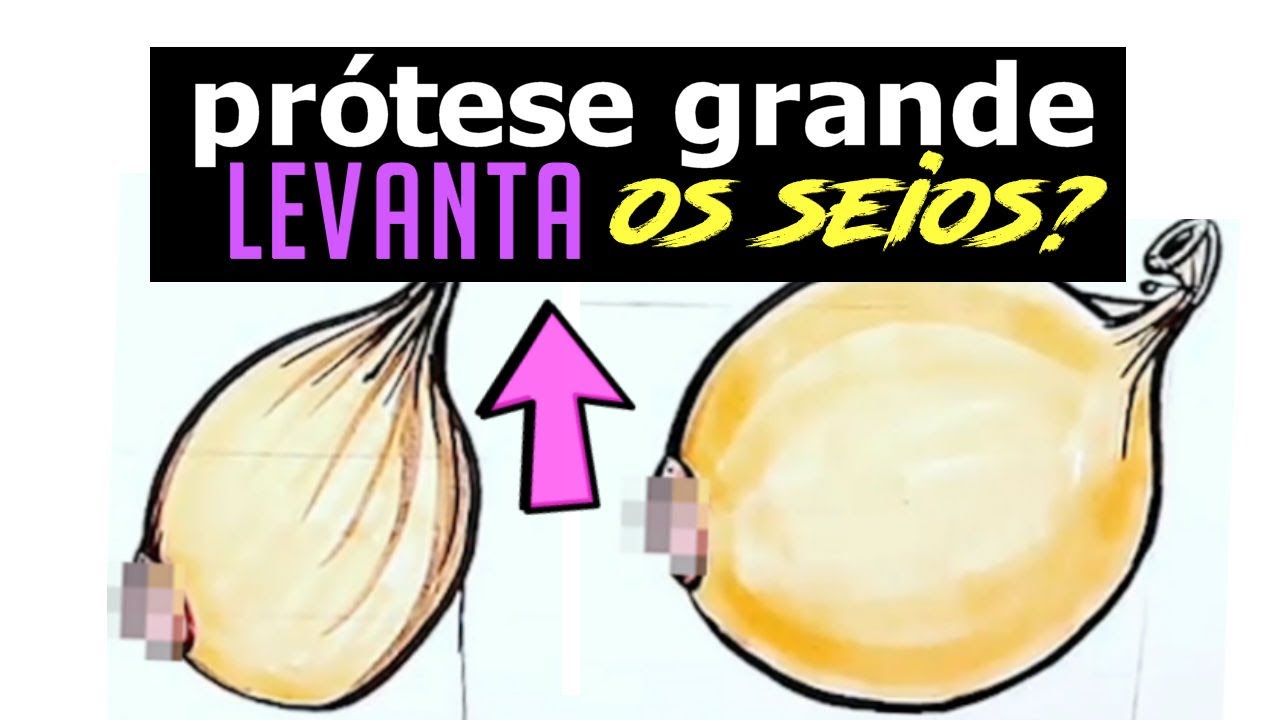 SILICONE Grande Levanta os Seios ou faz cair mais Antes e Depois Protese Mama