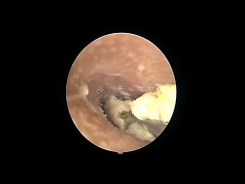 Ay nangangahulugan na ang mga halamang-singaw kamay Allergy mula ekzoderil