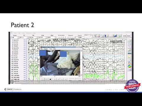 Epilepsy Awareness Day at DL 2021 - Maija Steenari, MD - Psychogenic Nonepileptic Seizures (PNES)