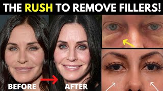 The 2022 Filler Trend: Why is everyone all of a sudden dissolving their fillers?