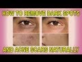 How to Remove Dark Spots and Acne Scars Naturally ...