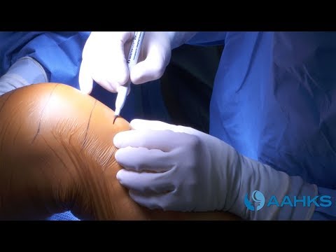 Partial Knee Replacement Surgery Video