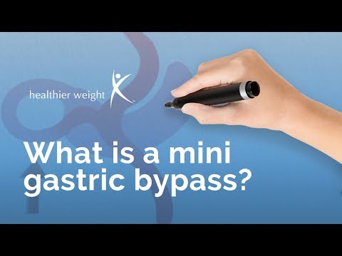 What is Mini Gastric Bypass Surgery