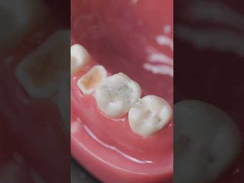 You Won&rsquo;t Believe How Easy It Is to Fix Your Teeth! 😲🦷 But Why Is It Always So Expensive?