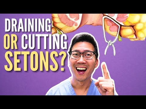 Seton: Draining or Cutting? | Anal fistula surgery