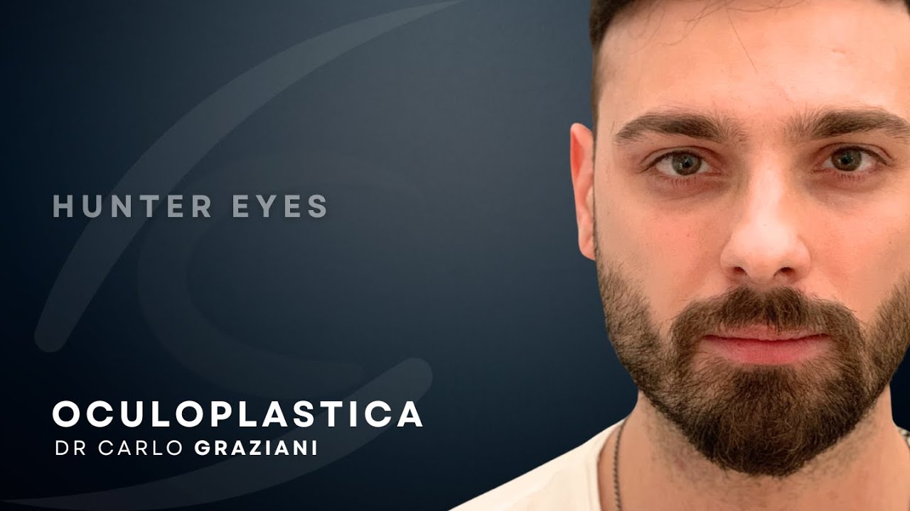 Oculoplastica | Prima dopo filler acido ialuronico hunter eyes uomo