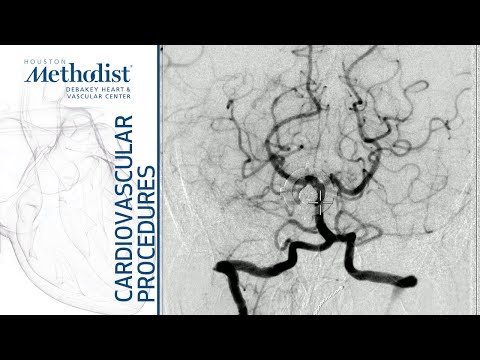 neuro-angiography-procedures Mp4 3GP Video & Mp3 Download unlimited Videos Download neuro-angiography-procedures Mp4 3GP Video & Mp3 Download unlimited Videos Download