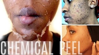 CHEMICAL PEEL! | Full Peeling Process |BEFORE &amp; AFTER | How To Get Rid of Hyperpigmentation