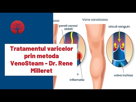 tratamentul venelor varicose venicoase pe picioarele scleroterapiei