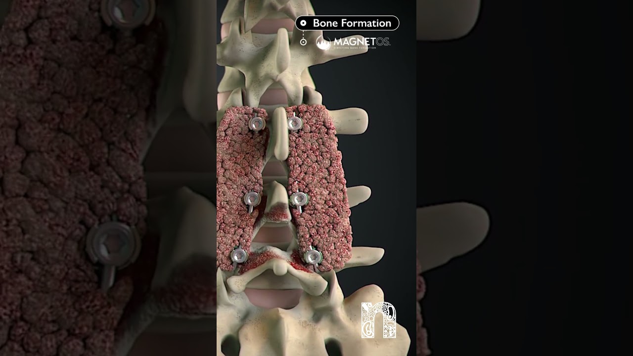 How MagnetOs can help you achieve a more predictable fusion | Medical Animation | MoA Animation