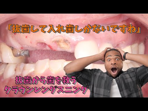 生命歯学科 「抜歯をして入れ歯しかない」ボロボロだけど歯を抜きたくない！抜歯をせずに歯を救うクラウンレングスニングとは