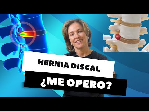 Hernia discal ¿me opero?