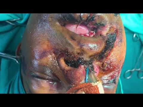 Comminuted Compound Poly Facial Trauma