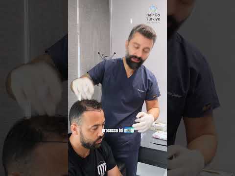 ✨ Transplante capilar na Turquia ✨