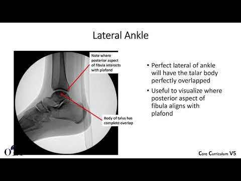 Ankle fractures - 1 of 4 - OTA CCv5