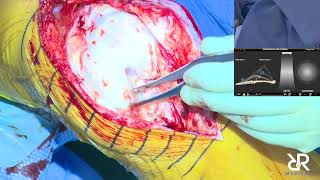 Dr. Stefan Kreuzer performs Left Total Knee Arthroplasty using OMNIBotics
