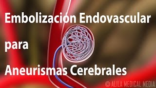 Embolización endovascular para aneurismas cerebrales