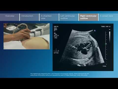 Key screening views of the fetal heart   Part 5   Right ventricular outflow
