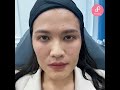 ร้อยไหม หน้าเรียว