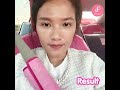 ร้อยไหม หน้าเรียว